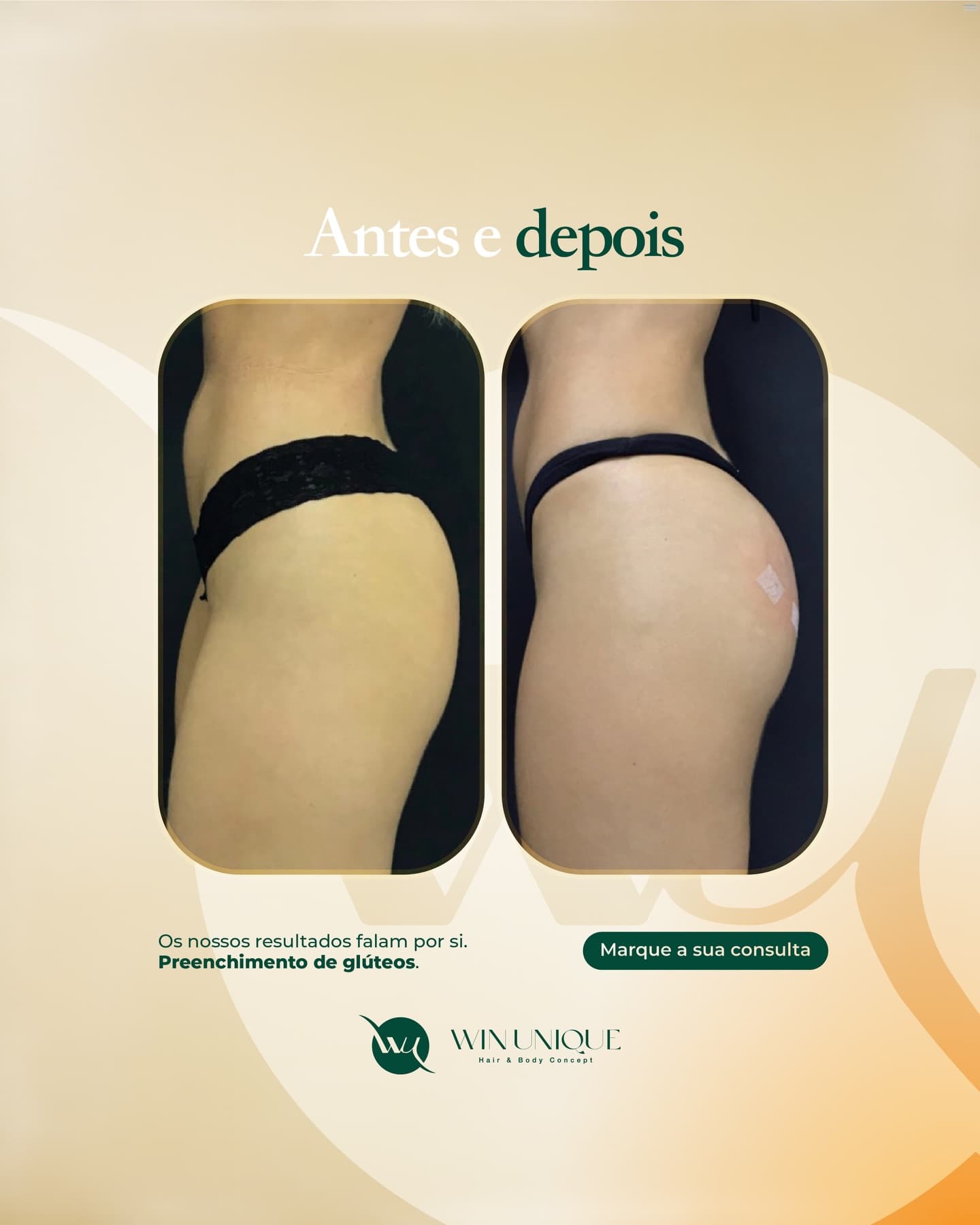 Antes e depois de preenchimento de glúteos na Win Unique Clinic, Lisboa.