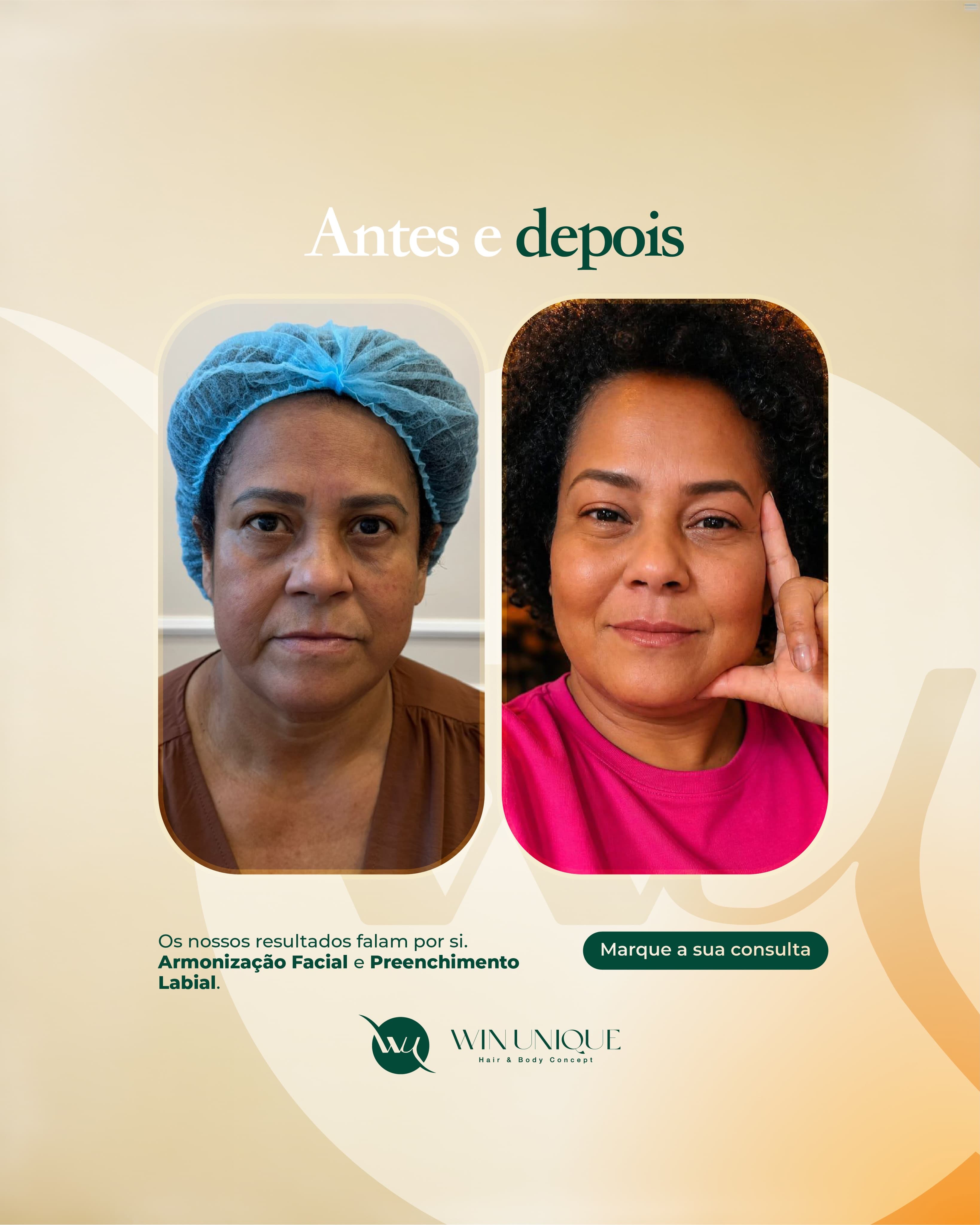 Antes e depois de harmonização facial e preenchimento labial na Win Unique Clinic, Lisboa.